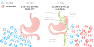 Why Do I Need Calcium After Bariatric Surgery - Bari Life