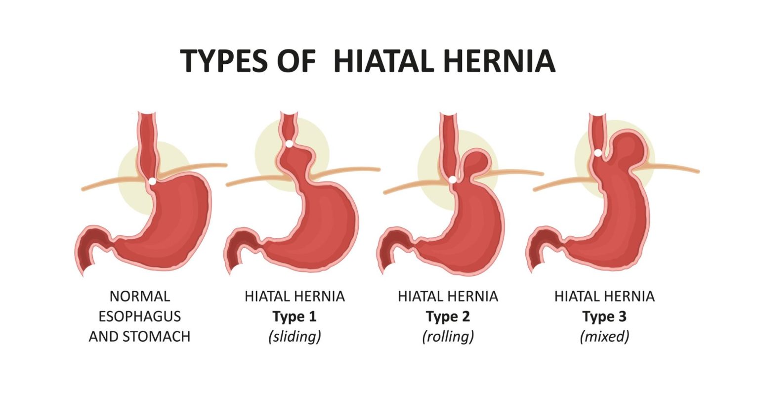 All About Hiatal Hernia After Gastric Bypass - Bari-Life