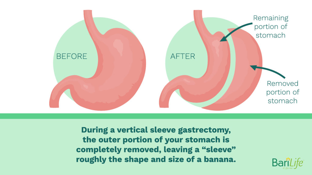 El antes y el después de su estómago después de la cirugía de manga gástrica