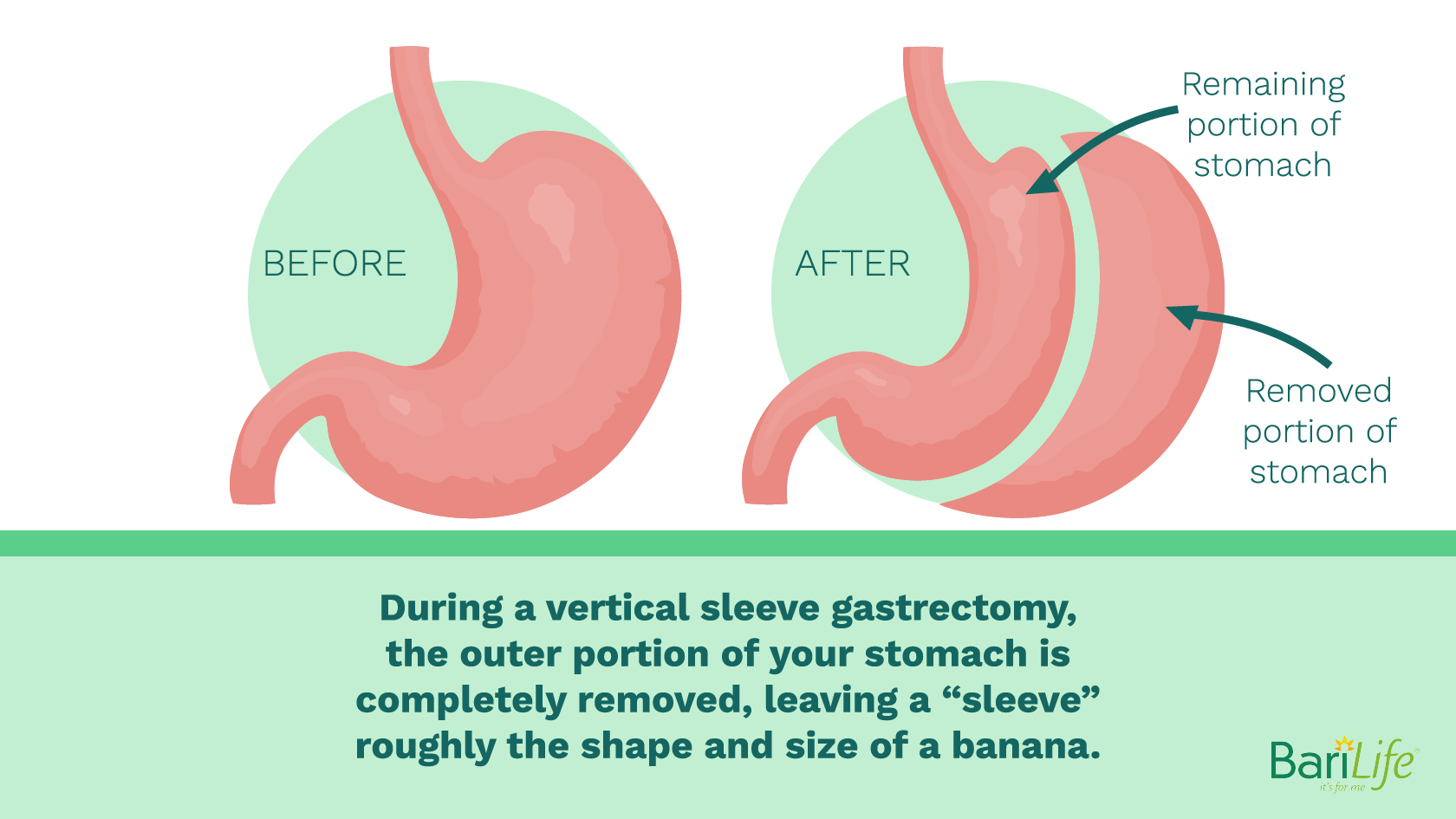 can-liquids-stretch-your-stomach-after-gastric-sleeve-surgery