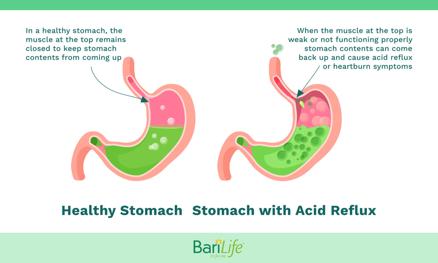 how-to-deal-with-heartburn-during-pregnancy-aimsnow7