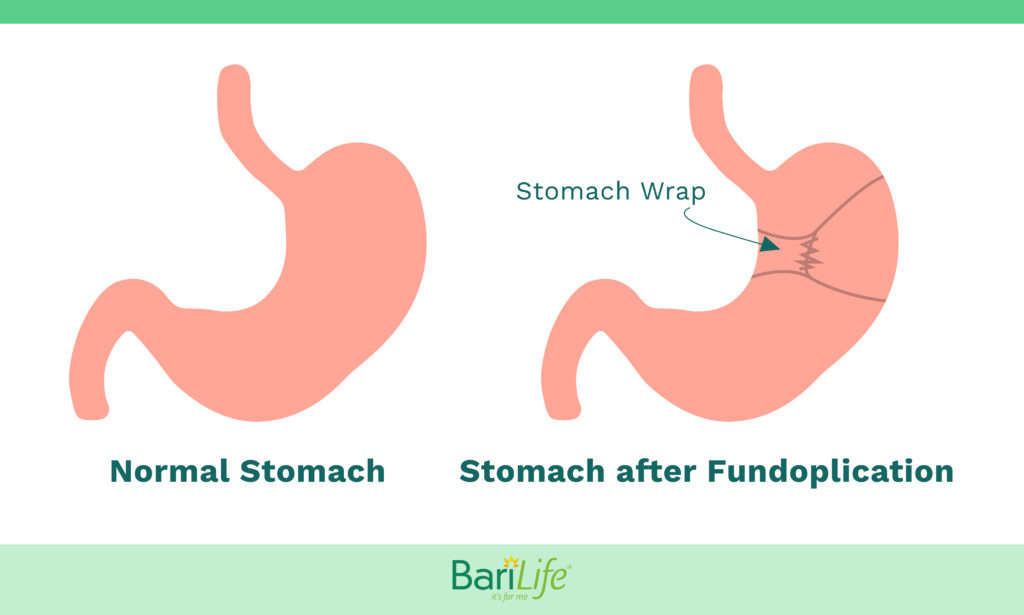 How Can I Fix My Acid Reflux After Gastric Sleeve Surgery 