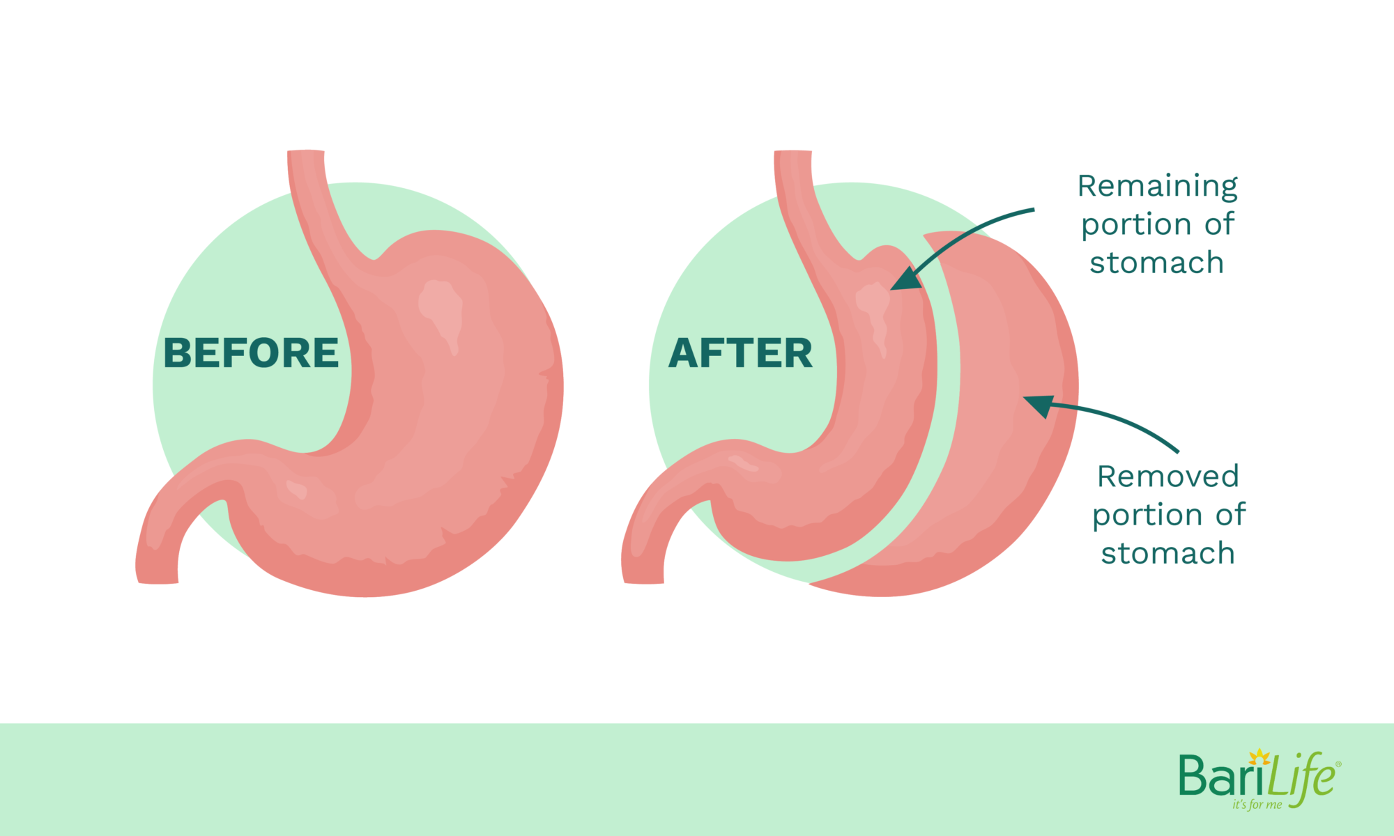 gastric-sleeve-surgery-importance-of-a-diet-plan-both-pre-and-post-g