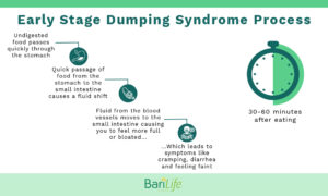 dumping syndrome gastric additionally elevated fluid tachycardia