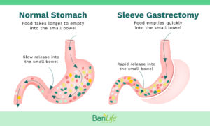 Dumping Syndrome After Gastric Sleeve: Symptoms, Causes and Cures