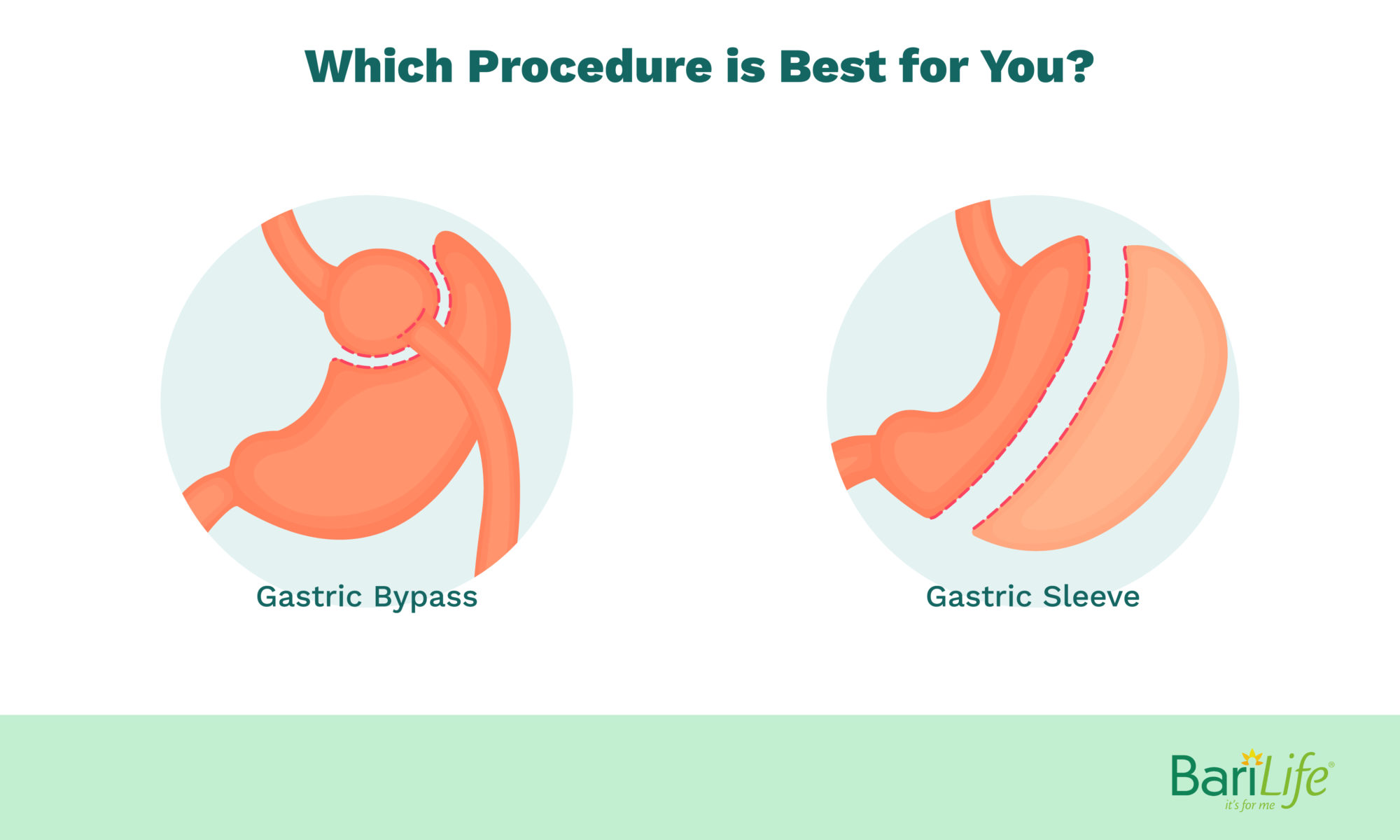 Gastric Sleeve Vs Gastric Bypass What Are The Pros And Cons 