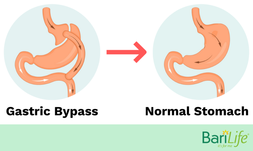 gastric-bypass-reversal-what-happens-after-it-s-reversed