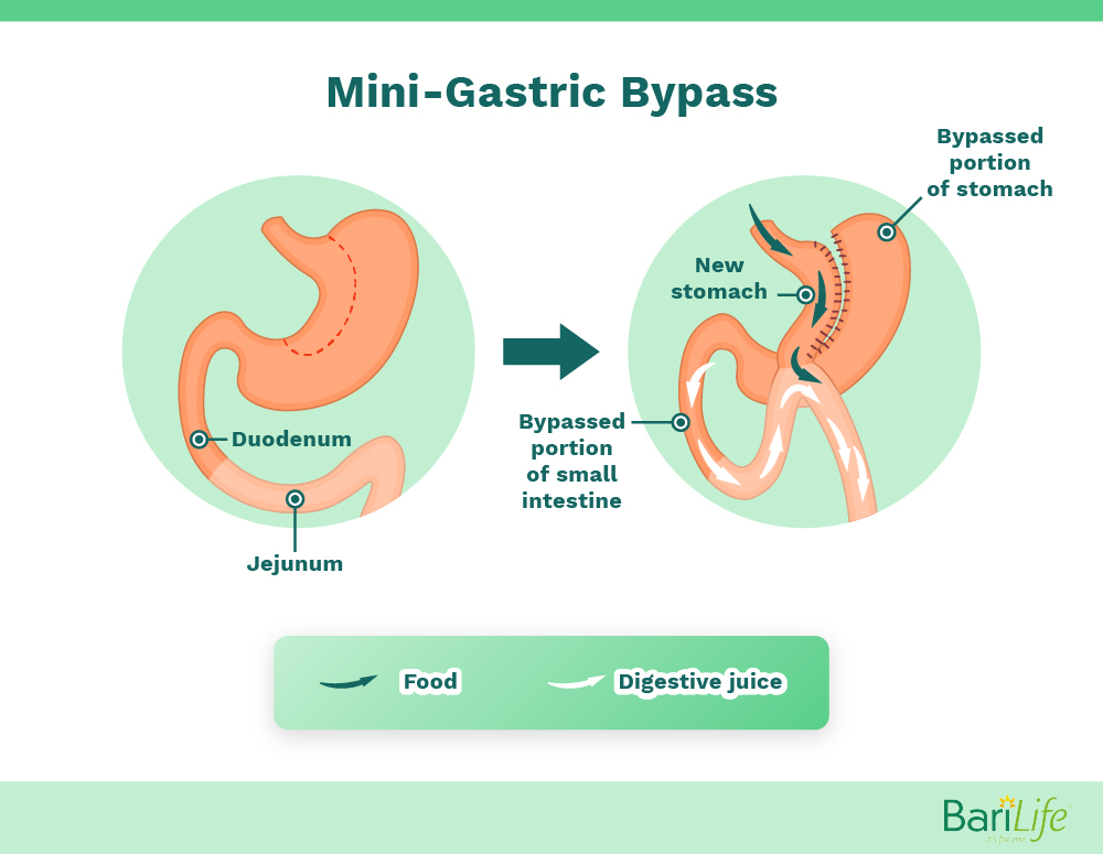 Mini Gastric Bypass Vs Rny Gastric Bypass What S The Difference