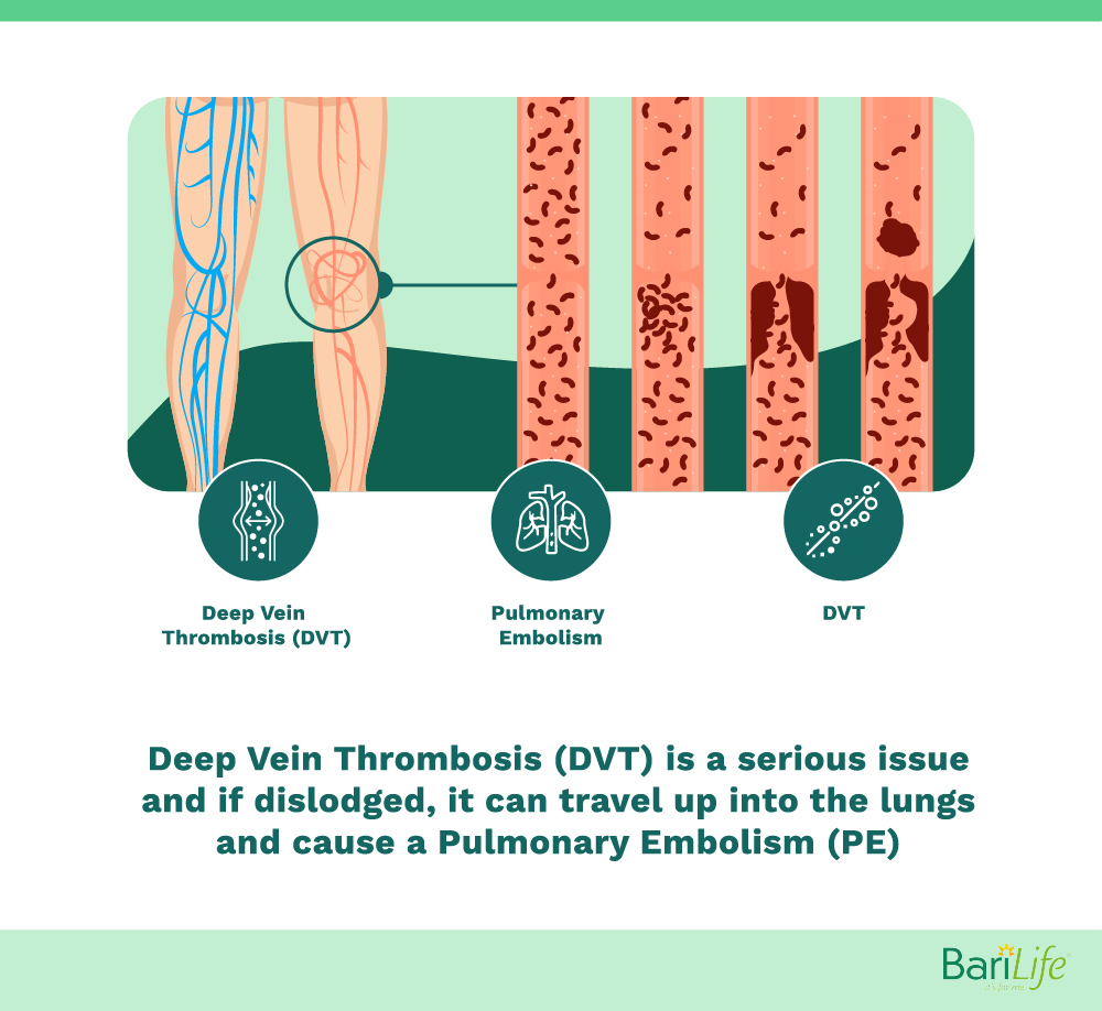 Deep vein thrombosis after gastric sleeve should be prevented