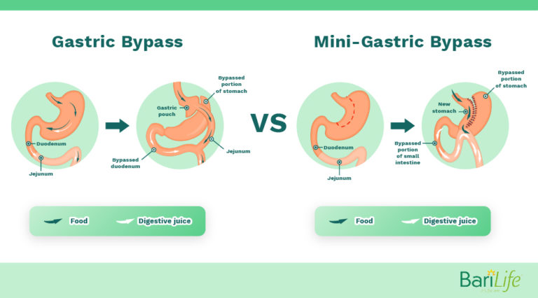 Mini Gastric Bypass Vs Rny Gastric Bypass Whats The Difference 