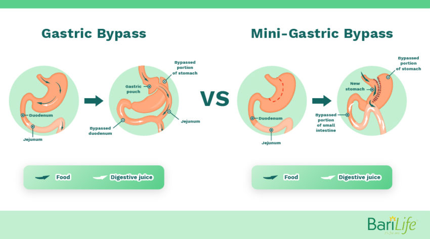 Mini gastric bypass vs. RNY Gastric bypass: What's the difference?