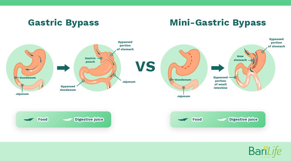 Mini Gastric Bypass Vs Rny Gastric Bypass What S The