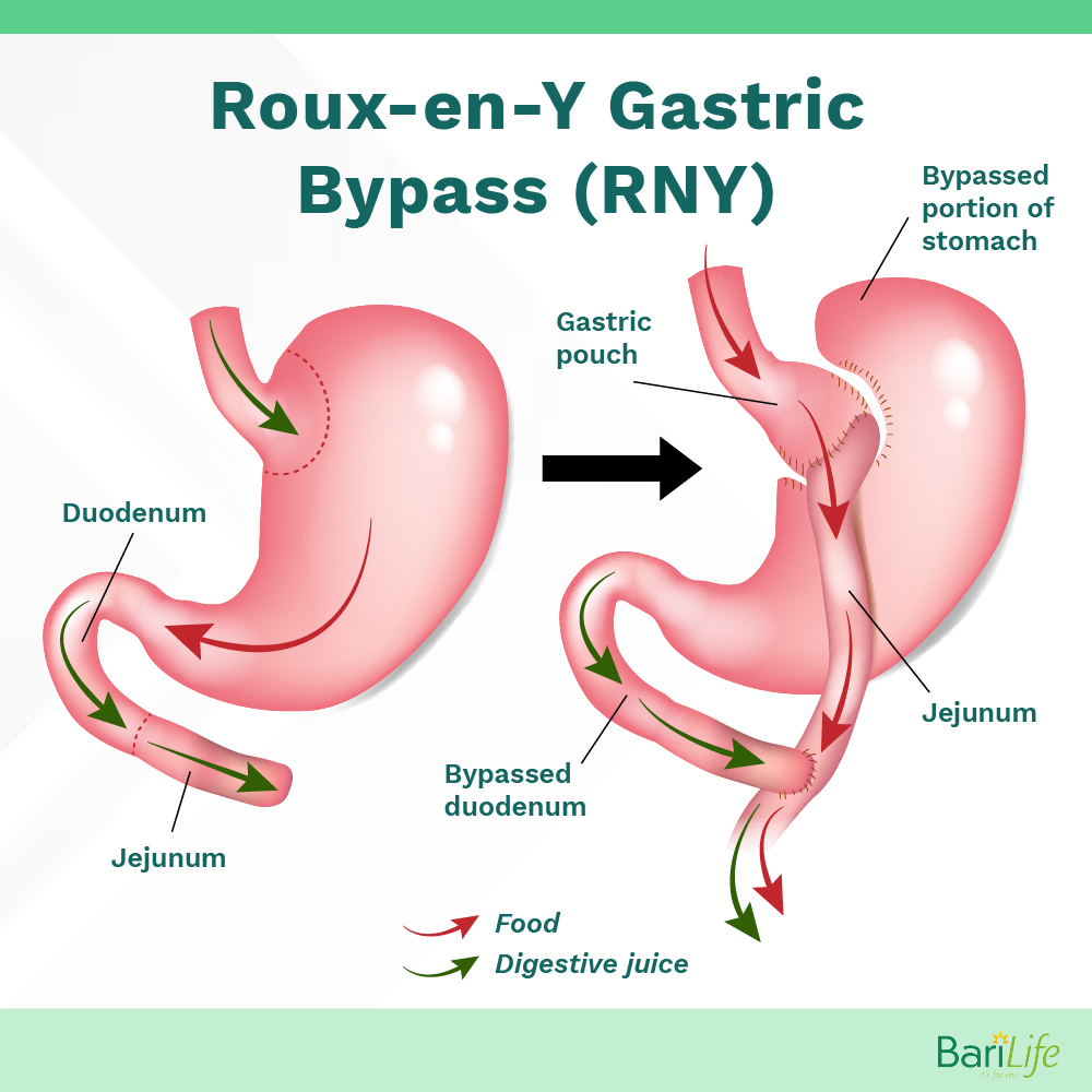 The Gastric Sleeve Explained