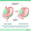 Can you have gastric sleeve after gastric bypass?