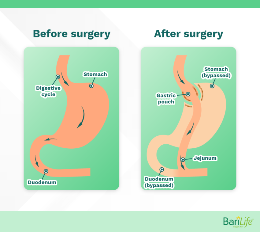 What is the Safest Form of Weight Loss Surgery? Bari Life