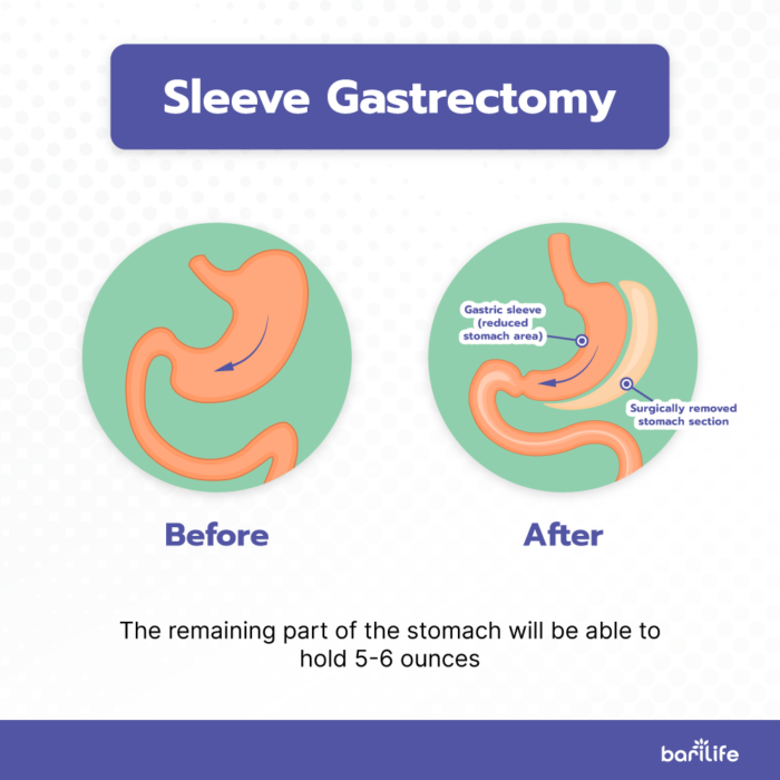 Gastric sleeve 10 years later - Keep the weight off and stay healthy