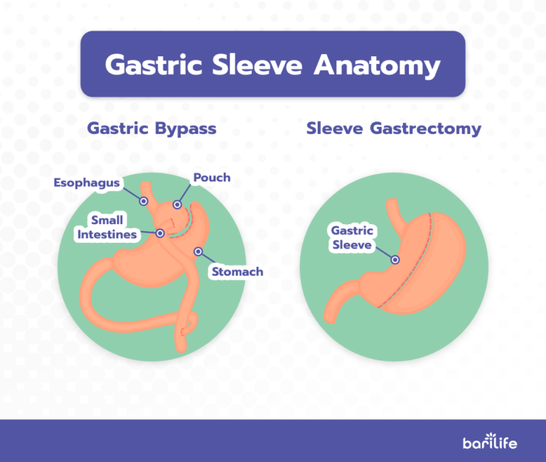 Gastric Sleeve Incisions Everything You Need To Know 0785