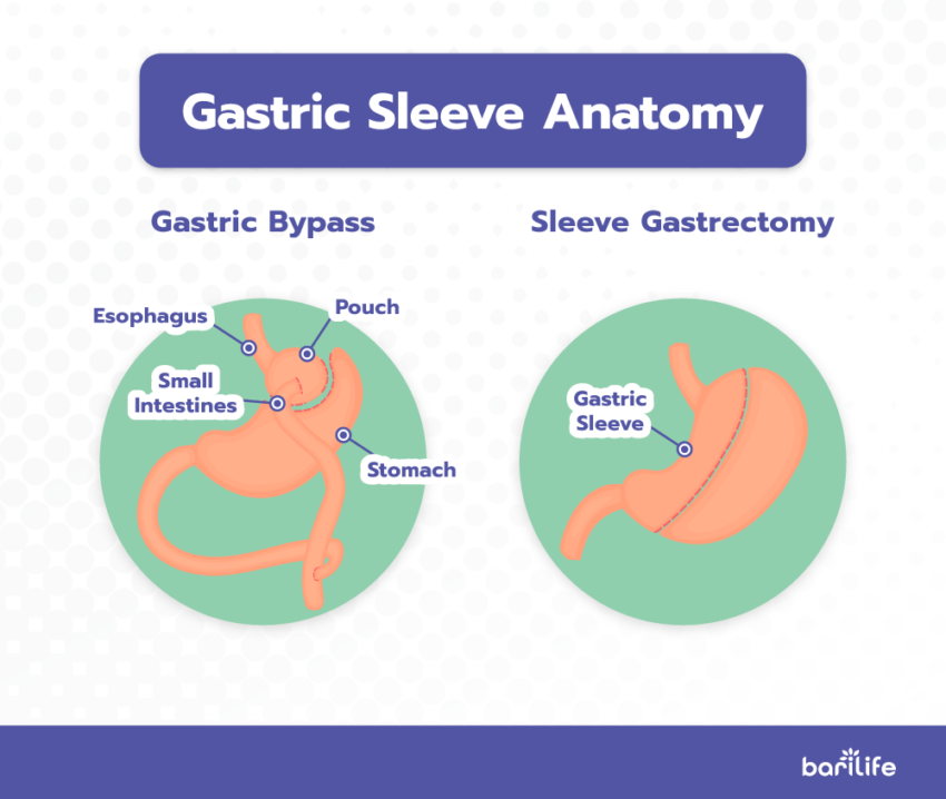 Gastric Sleeve Incisions - Everything you need to know!