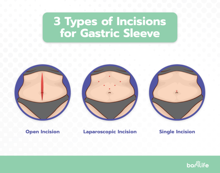 Gastric Sleeve Incisions - Everything you need to know!