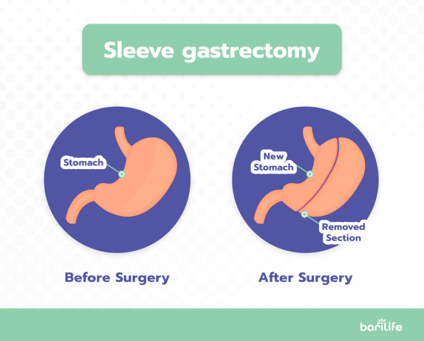 How to restart weight loss after gastric sleeve: Full Guide