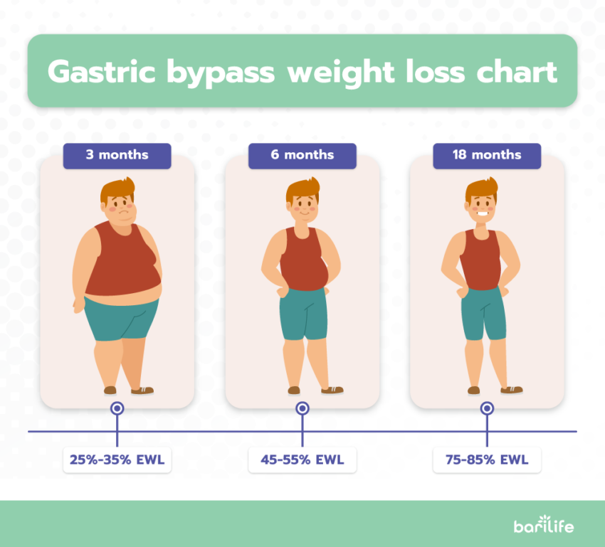 gastric bypass surgery weight loss journey