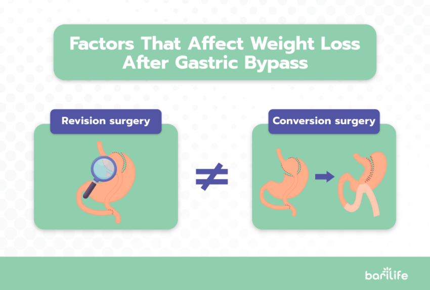 Gastric Bypass Revision Surgery Everything You Need To Know