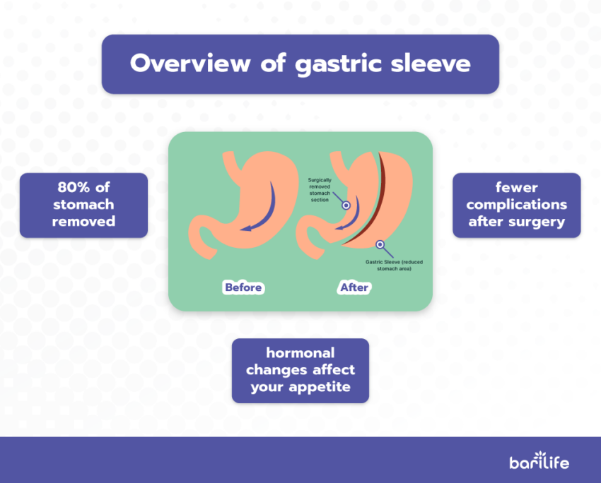 exactly-how-long-gastric-sleeve-surgery-will-take-full-guide