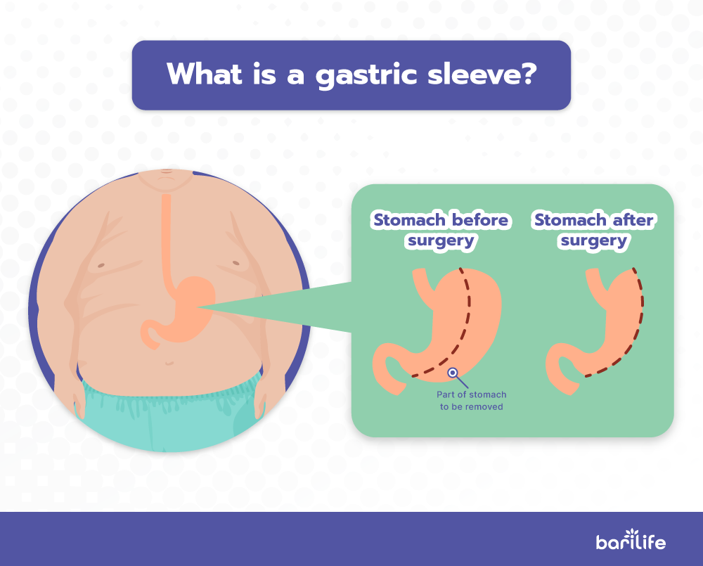 What is a gastric sleeve surgery?