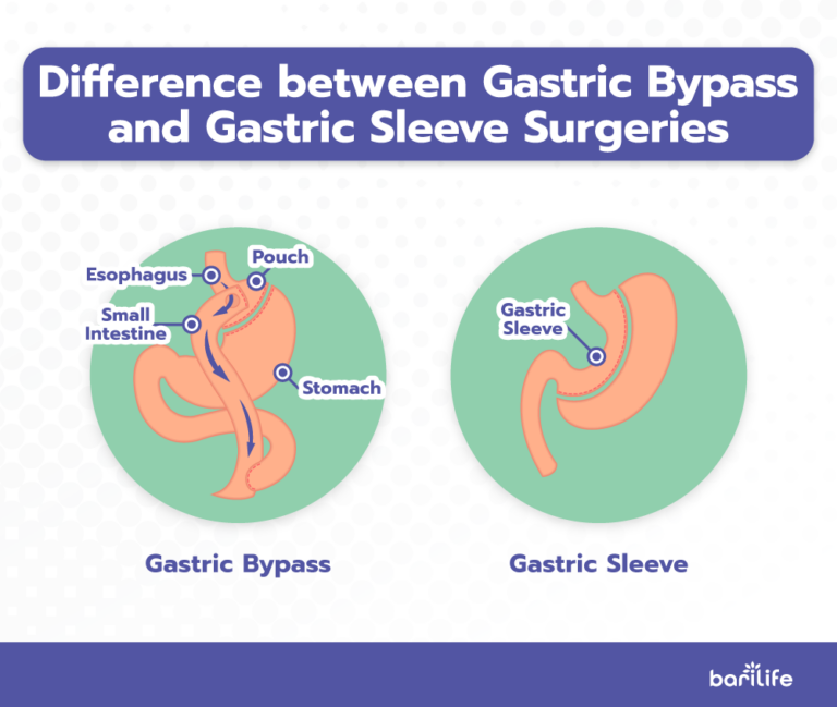 Gastric Bypass Success Rate Bari Life