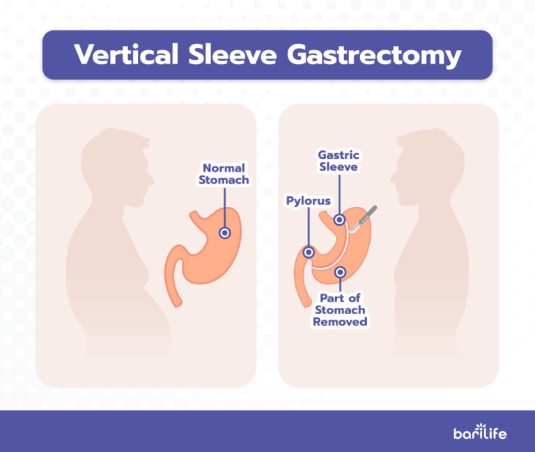 What does a gastric sleeve leak feel like? - Bari Life