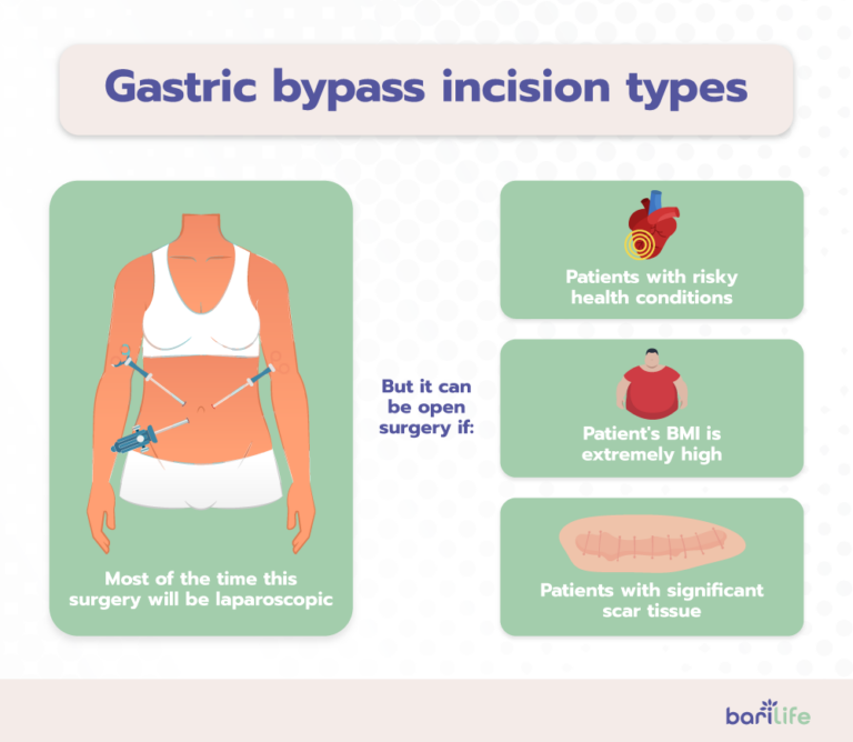 Gastric Bypass Incisions Everything You Need To Know 2121