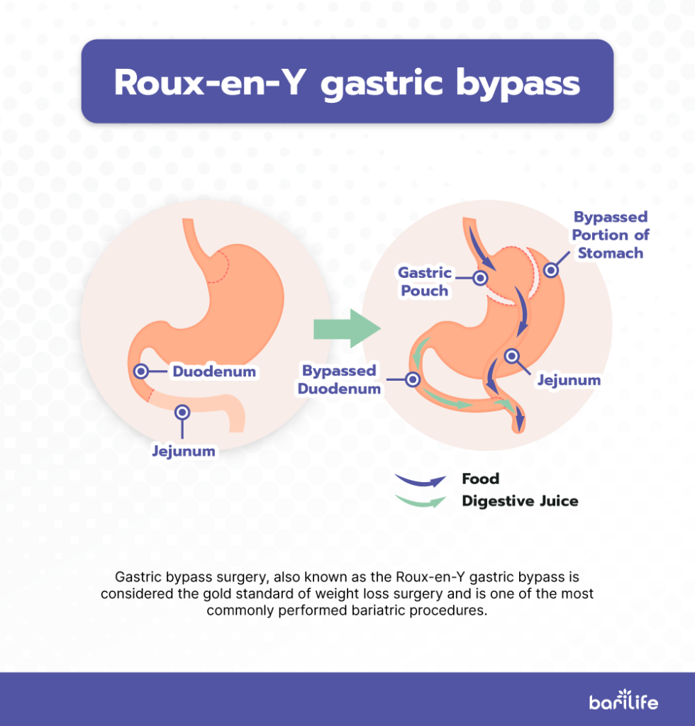 Anatomy of roux-en-y gastric bypass