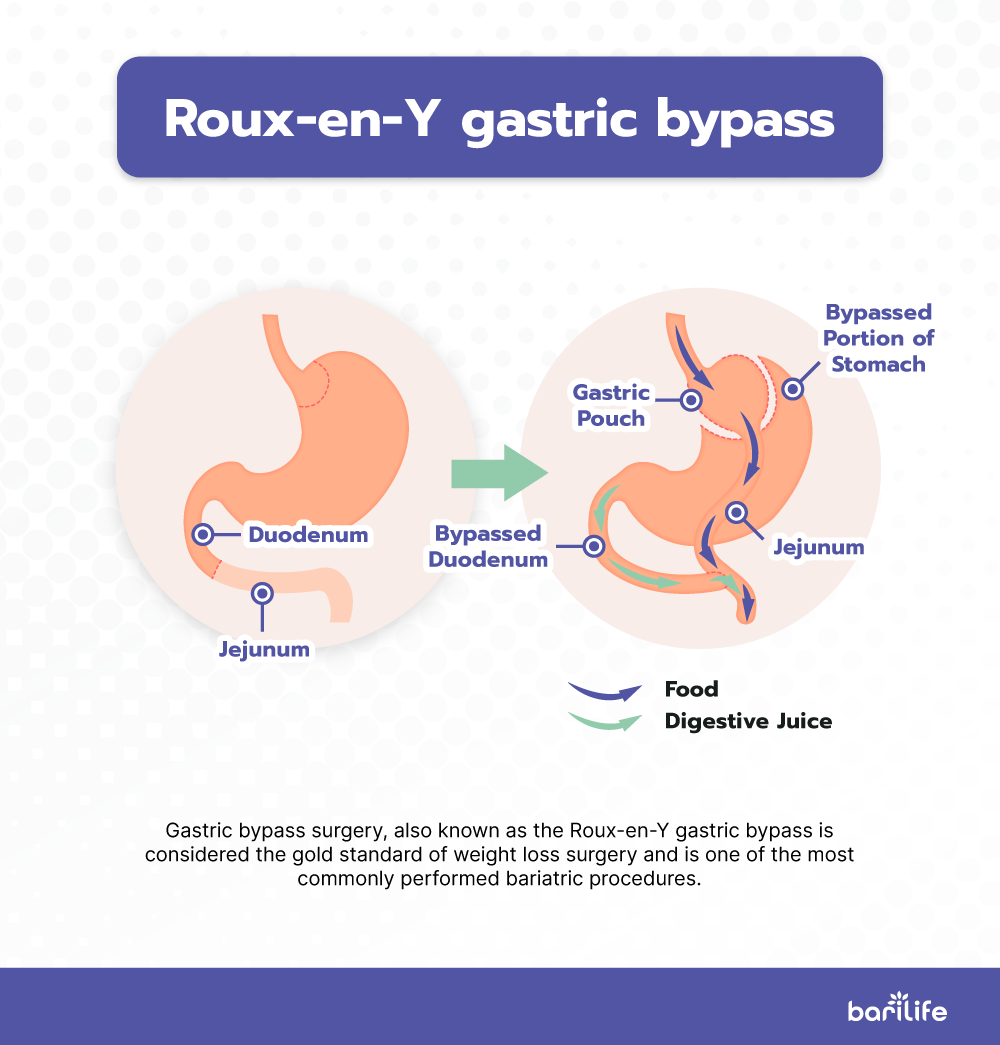 Gaining Weight After Gastric Bypass What To Do To Right Now 4736