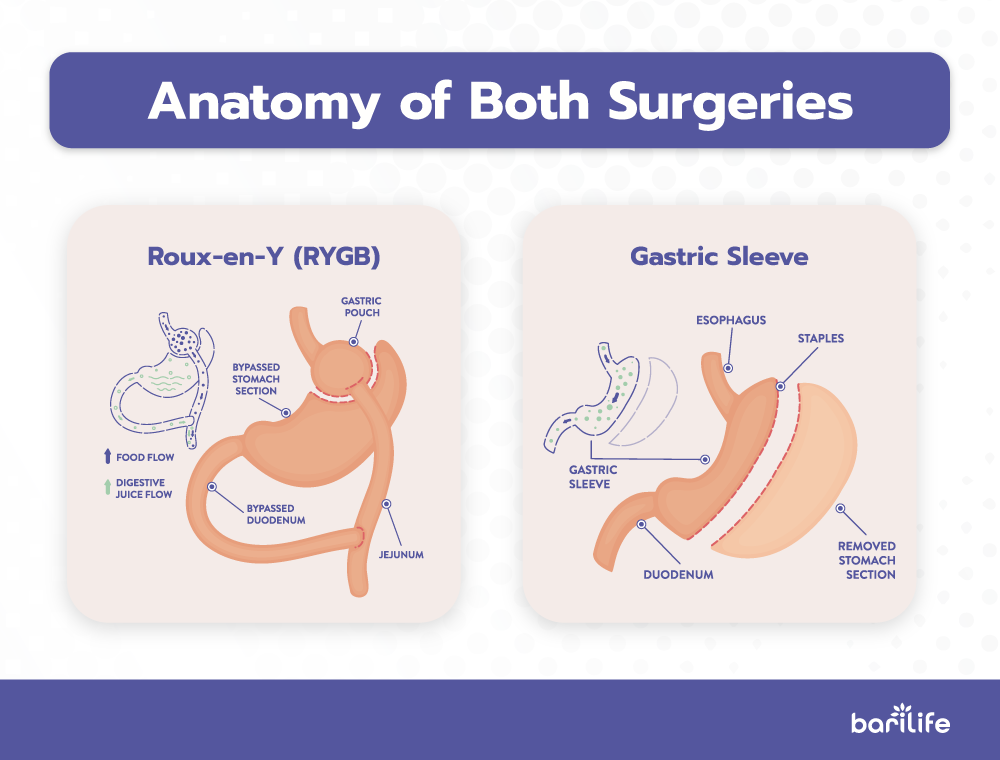 Anatomy of gastric bypass surgery vs sleeve