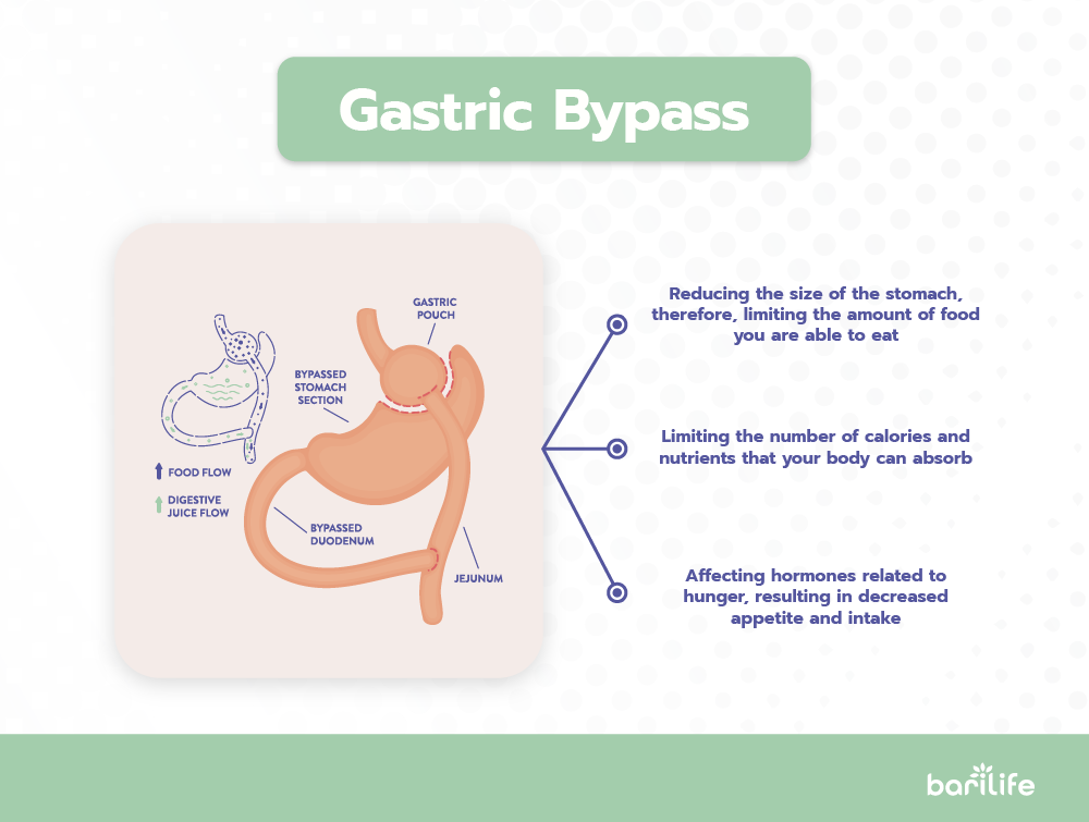 Anatomy diagram of the gastric bypass surgery
