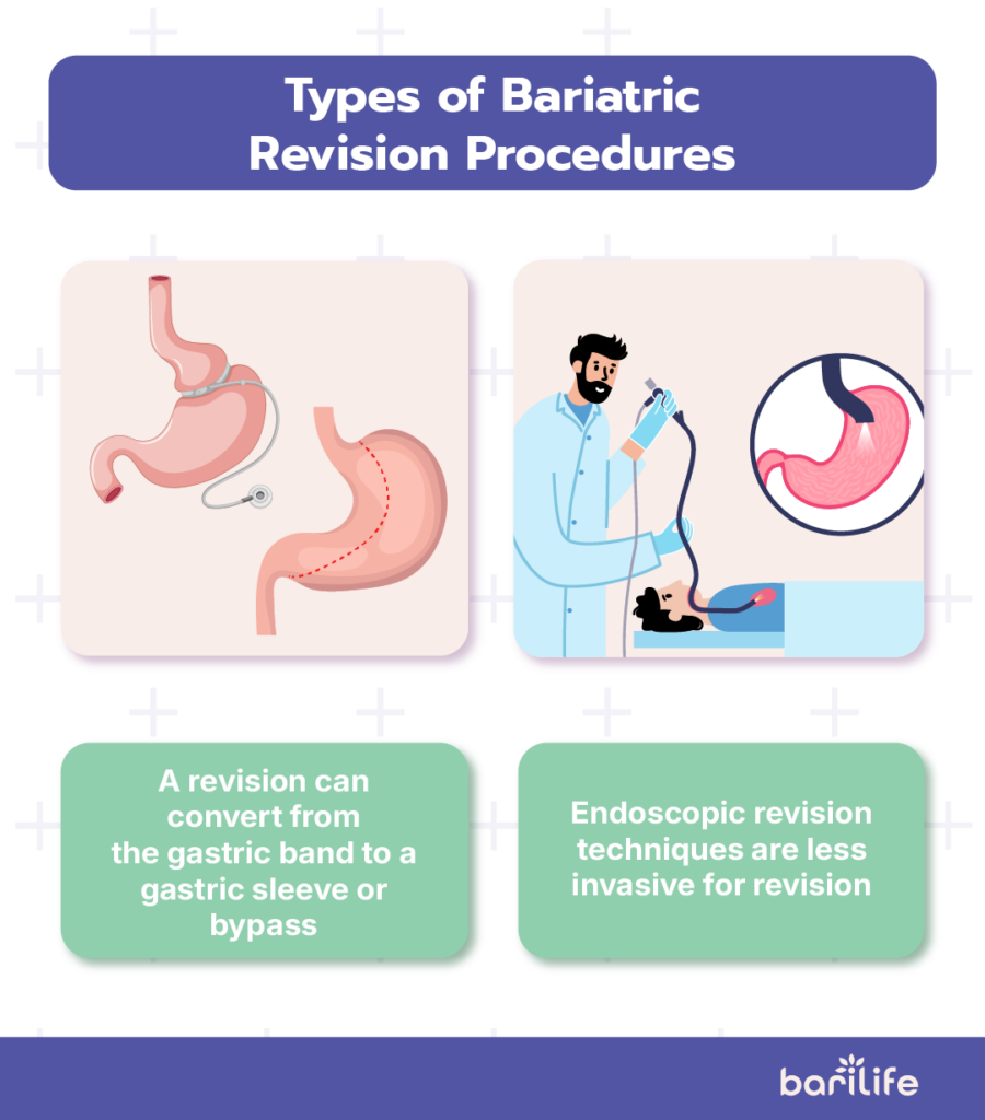 revision bariatric surgery