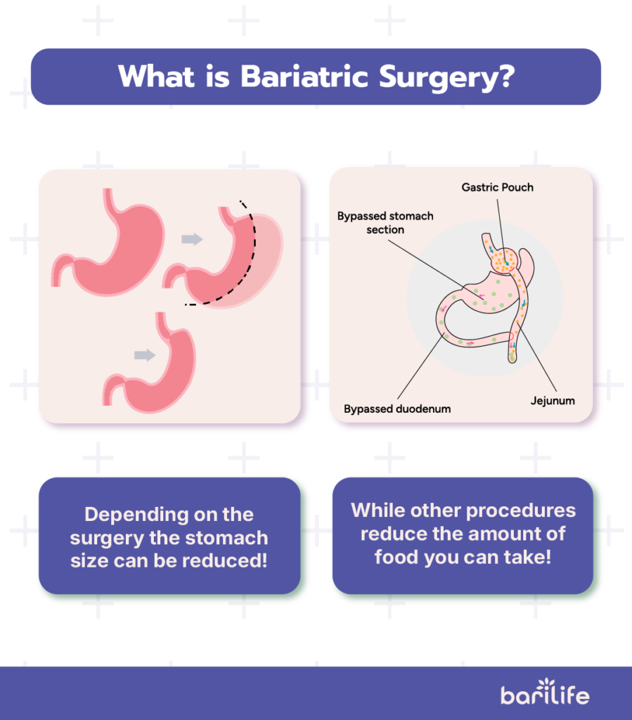 what is bariatric surgery